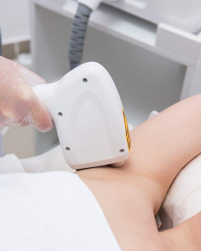 Epilation au laser des aisselles