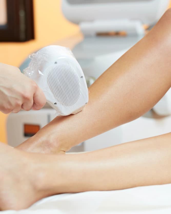 Epilation au laser des jambes